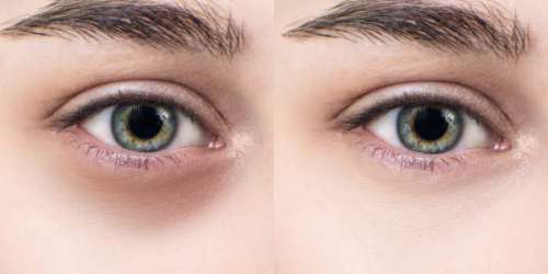 از بین بردن حلقه های سیاه دور چشم (روش های پیشگیری و درمان سیاهی دور چشم)