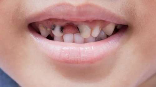 اگر دندان های شیری کودک را درمان نکنیم چه می شود؟
