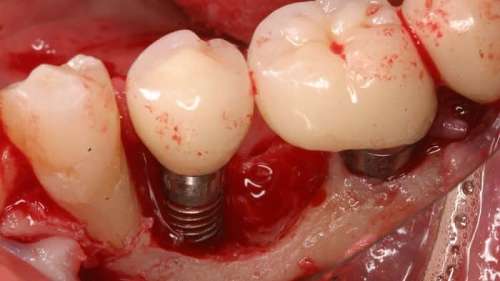 عفونت ایمپلنت دندان چه دلایلی دارد؟ چگونه درمان می شود؟