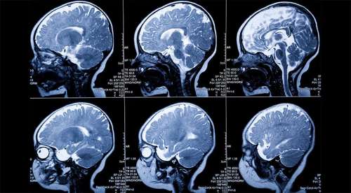 تراپی‌های تحریک مغز برای آلزایمر: آنچه باید بدانید