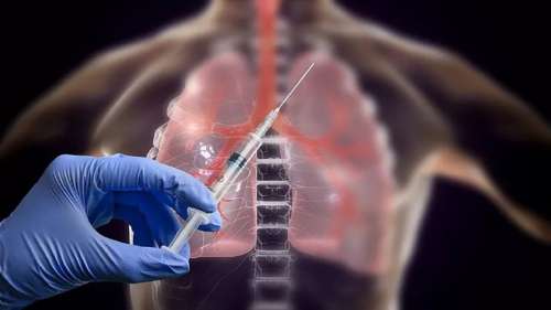 ساخت واکسن سرطان ریه که تا 41 درصد در کاهش نرخ مرگ‌ومیر موثر است