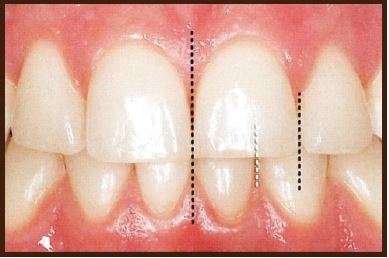 میدلاین دندان چیست؟ روش درمان و انواع میدلاین