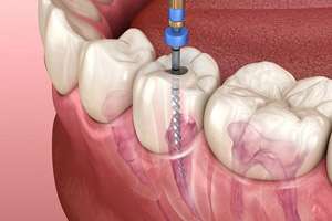 عصب کشی دندان چیست؟ 0 تا 100 مراحل عصب‌ کشی دندان