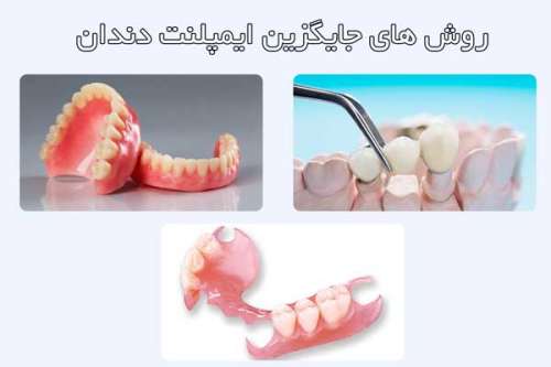 روش های جایگزین ایمپلنت دندان