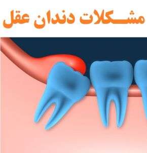 دندان عقل چه مشکلات و دردهایی ایجاد می کند؟
