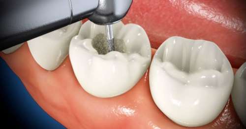 درد دندان عصب کشی شده: علت این درد و راه های درمانی آن که باید بدانید