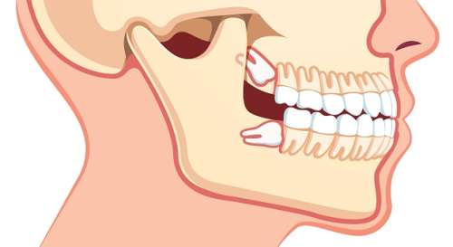 عصب کشی دندان عقل: آیا درمان کانال ریشه دندان عقل لازم است؟