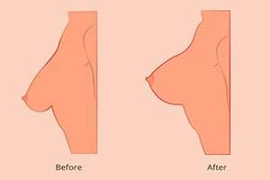 روش های بالا بردن نوک سینه زنان (عکس)