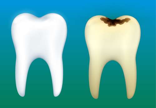پوسیدگی دندان: علل، علائم و توصیه‌های مهم برای جلوگیری و درمان پوسیدگی