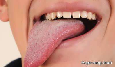 درمان تاول زبان با انواع راهکارهای خانگی و گیاهی