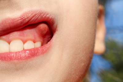 علایم، پیشگیری و درمان کیست دندان