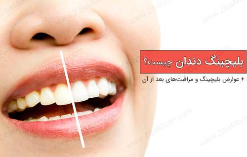 بلیچینگ دندان چیست و چه عوارضی دارد؟