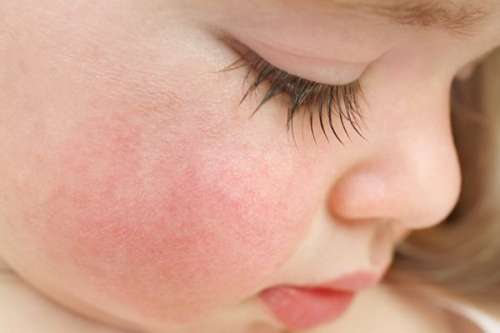 انواع مشکلات پوستی کودکان و راهکارهای درمانی آنها